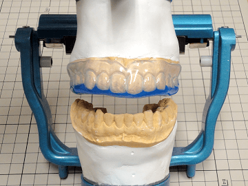 オプション　噛み合わせ