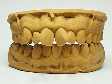 製造工程　マウスピース　歯形模型