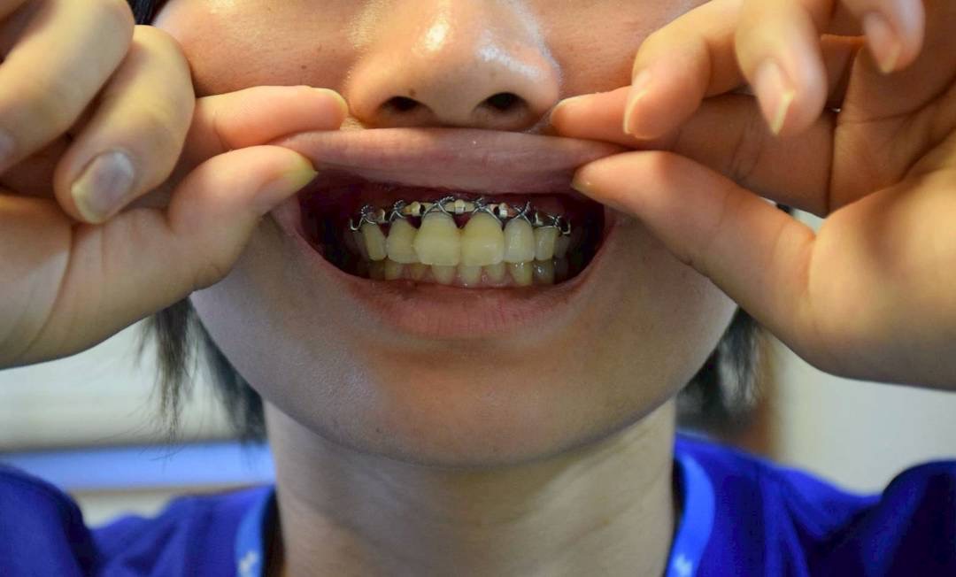 スポーツ中の歯のトラブル実例と対策